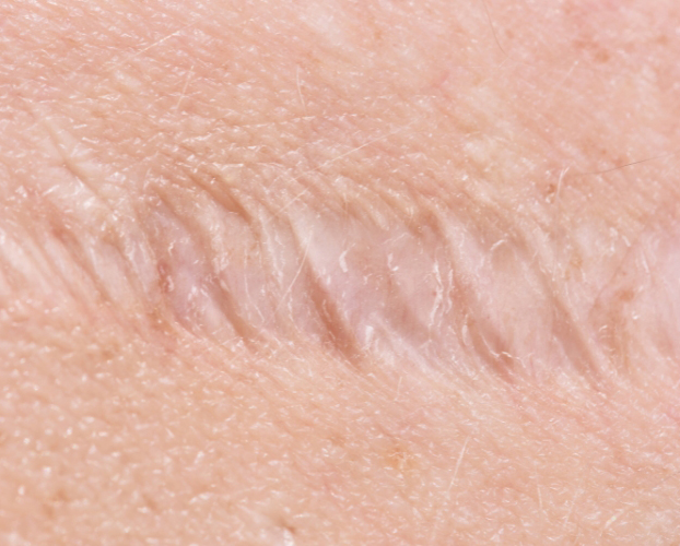 Trị Sẹo Rỗ Sẹo Lõm Bằng Laser Tại Sen Beauty
